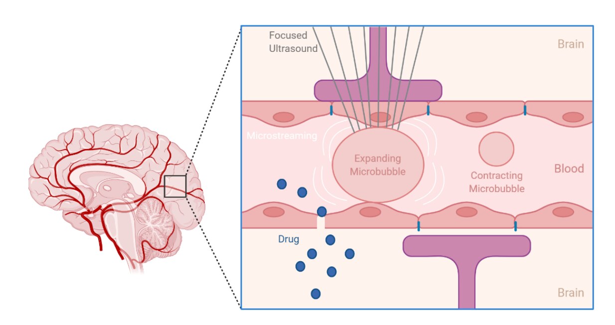 Schéma montrant des microbulles activées par ultrasons qui ouvrent temporairement la barrière hémato-encéphalique