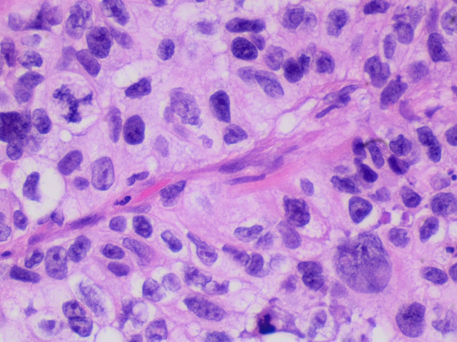 Coupe de tissu pulmonaire colorée en rose et violet, montrant des cellules cancéreuses aux noyaux irréguliers